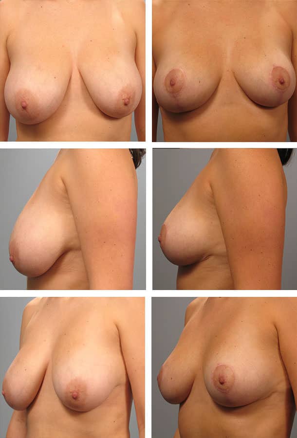 Before and After Image: Breast Lift - other