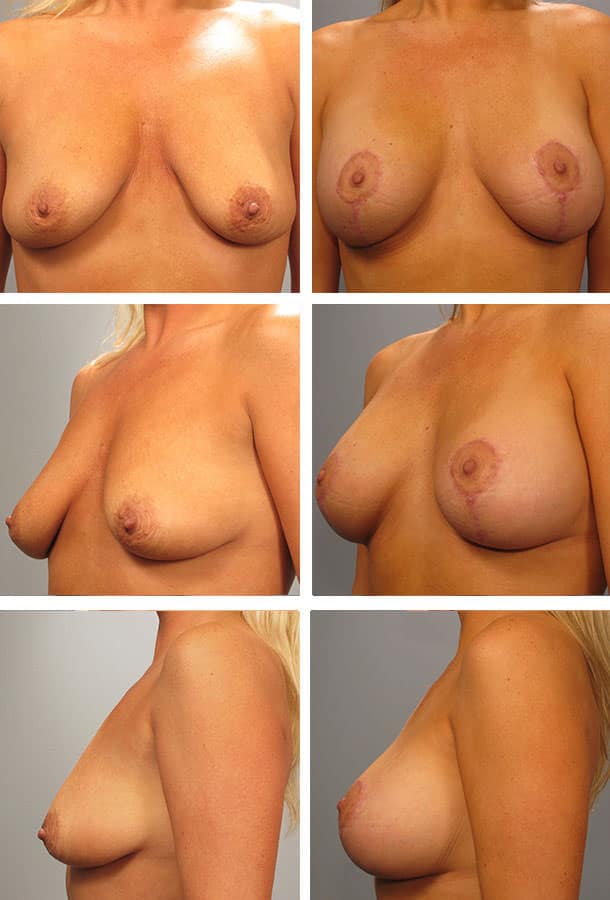 Before and After Image: Breast Lift - other
