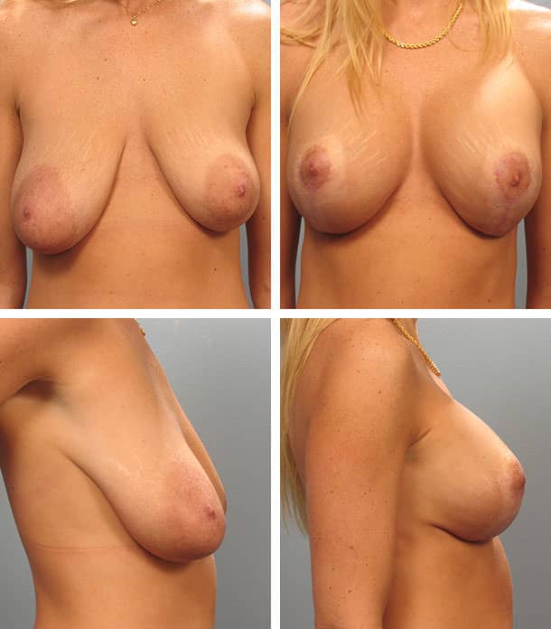 Before and After Image: Breast Lift with Augmentation - other