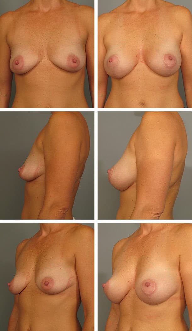 Before and After Image: Breast Lift with Augmentation - other