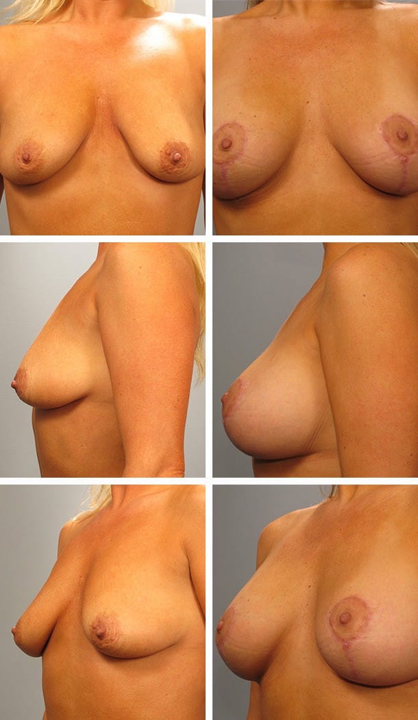 Before and After Image: Breast Lift with Augmentation - other