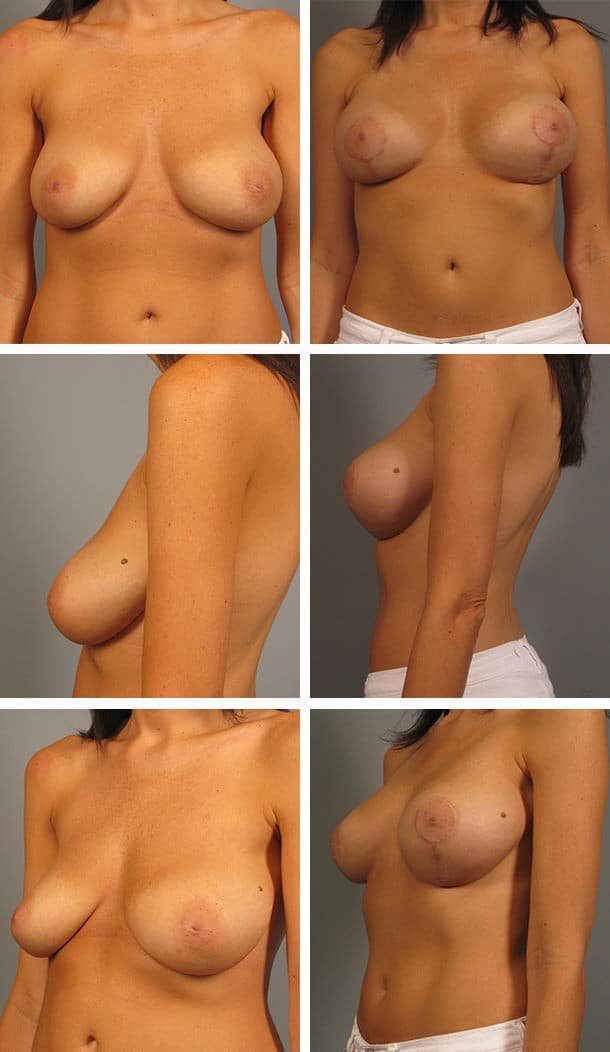 Before and After Image: Breast Lift with Augmentation - other