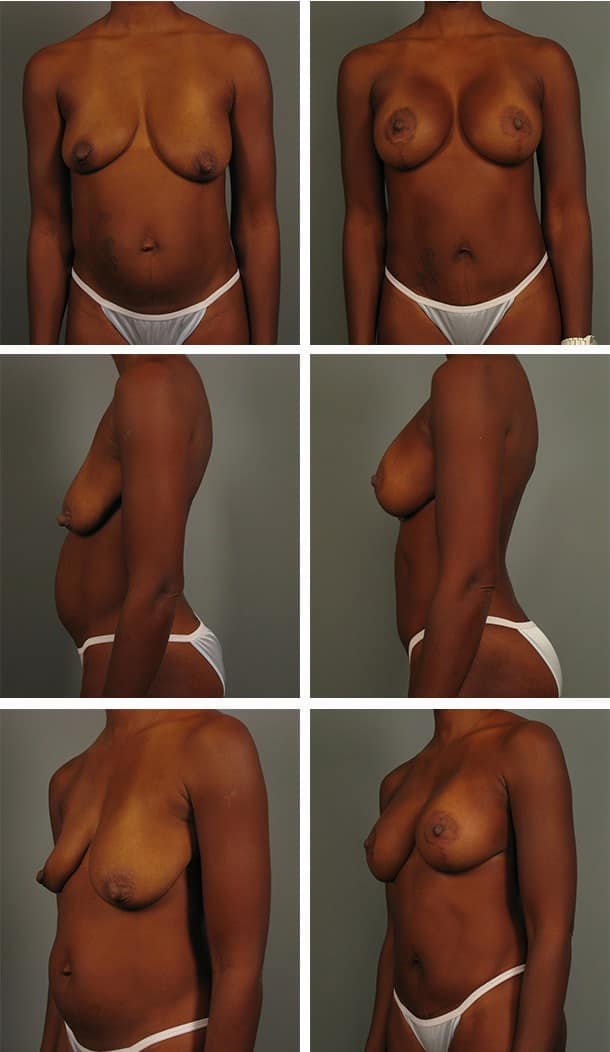 Before and After Image: Breast Lift with Augmentation - other