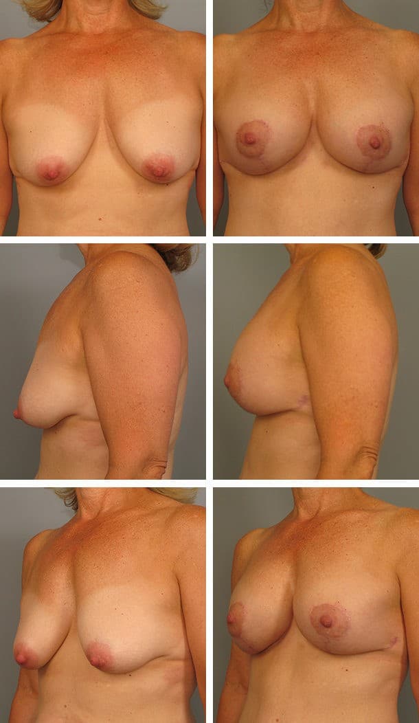 Before and After Image: Breast Lift with Augmentation - other