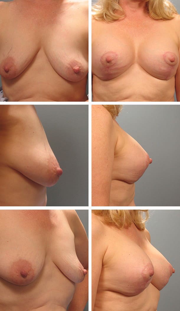 Before and After Image: Breast Lift with Augmentation - other