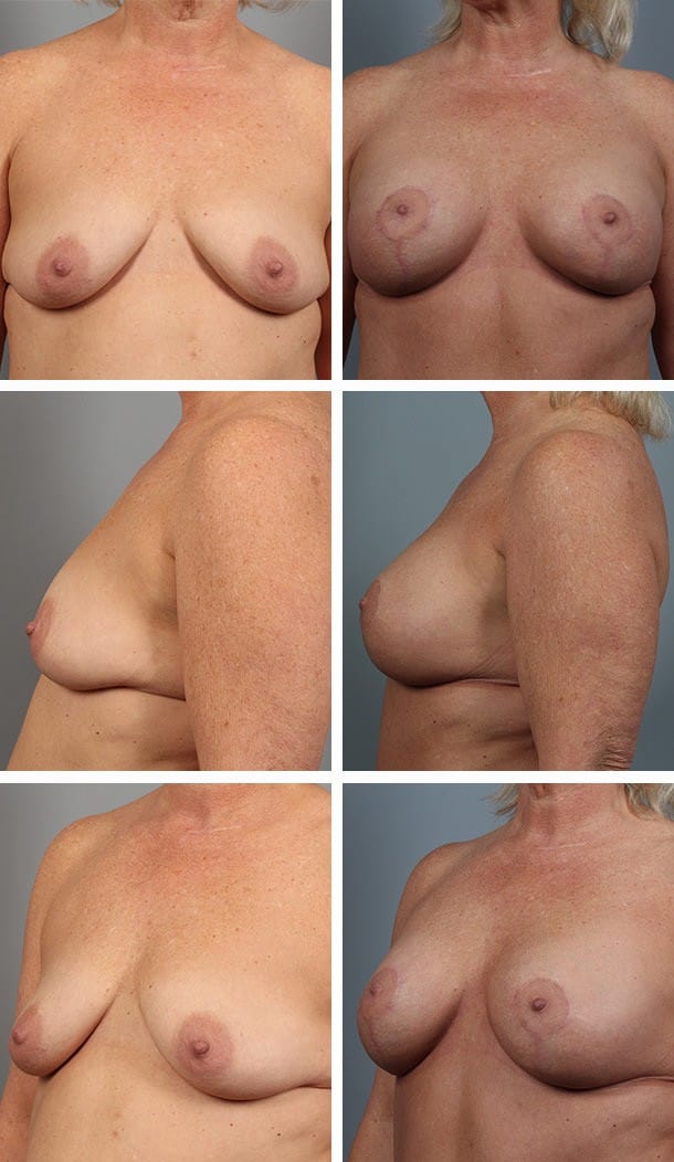Before and After Image: Breast Lift with Augmentation - other
