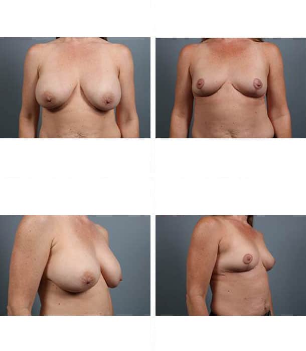 Before and After Image: Breast Lift with Augmentation - other