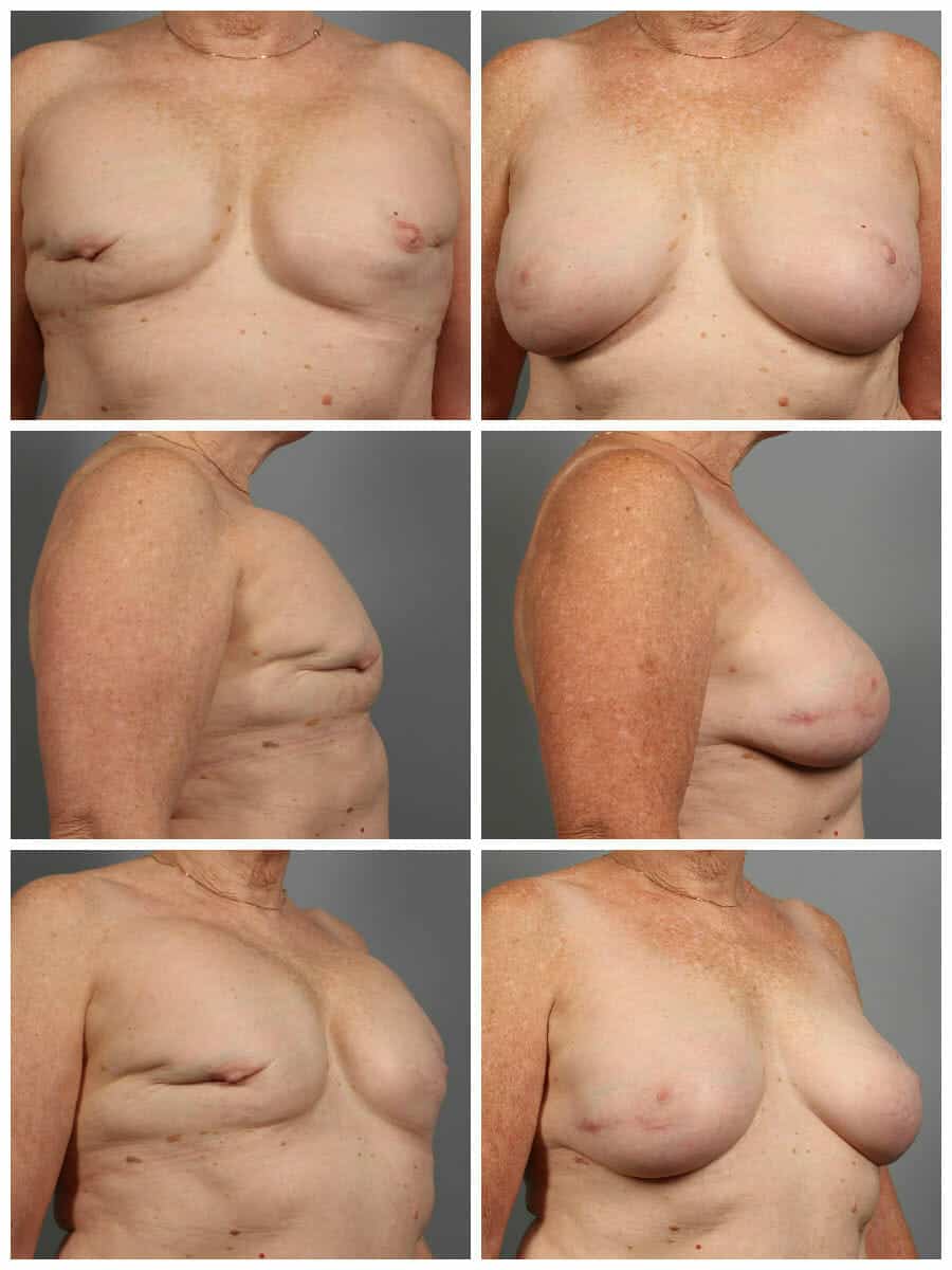 Before and After Image: Breast Reconstruction - other