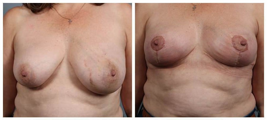 Before and After Image: Breast Reconstruction - front