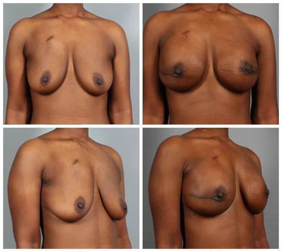 Before and After Image: Breast Reconstruction - other