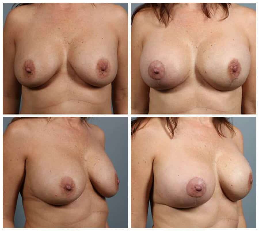Before and After Image: Breast Reconstruction - other