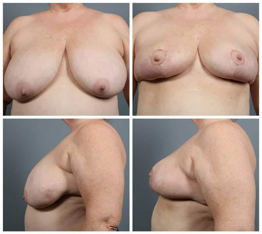Before and After Image: Breast Reconstruction - other