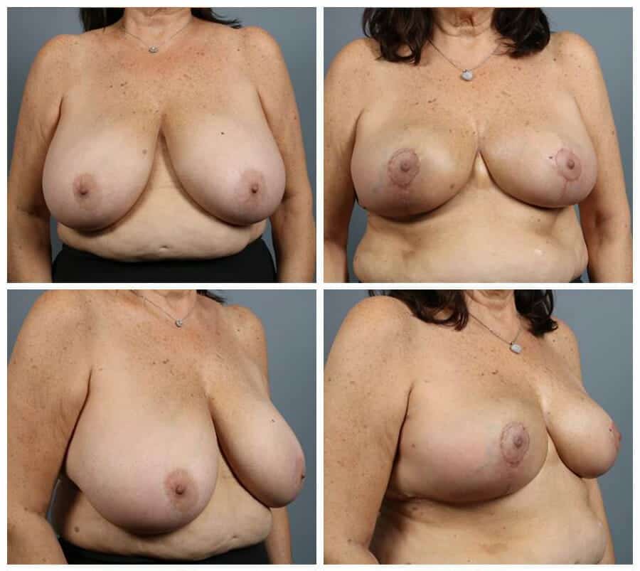 Before and After Image: Breast Reconstruction - other