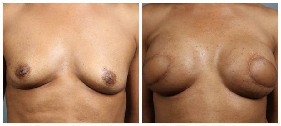 Before and After Image: Breast Reconstruction - front