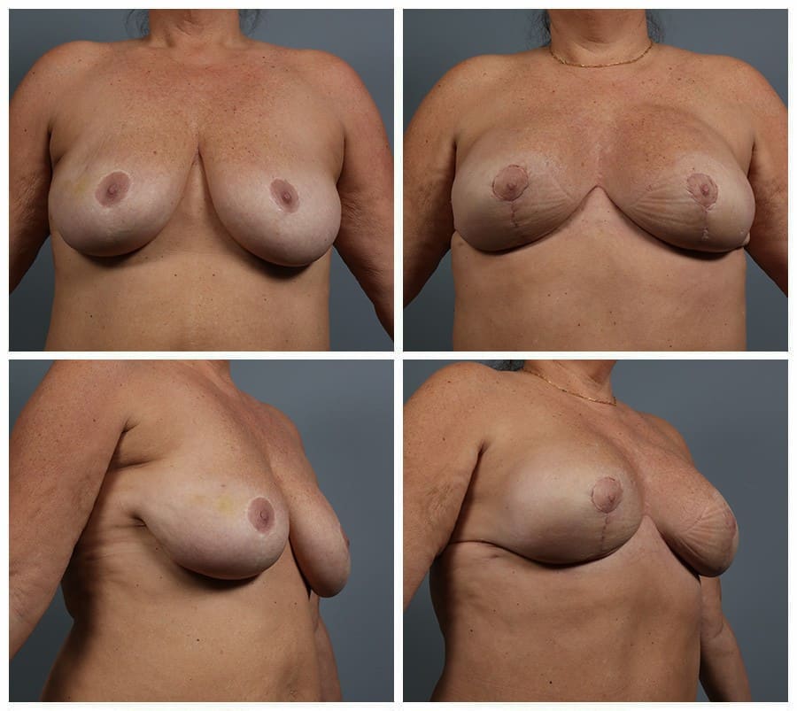 Before and After Image: Breast Reconstruction - other
