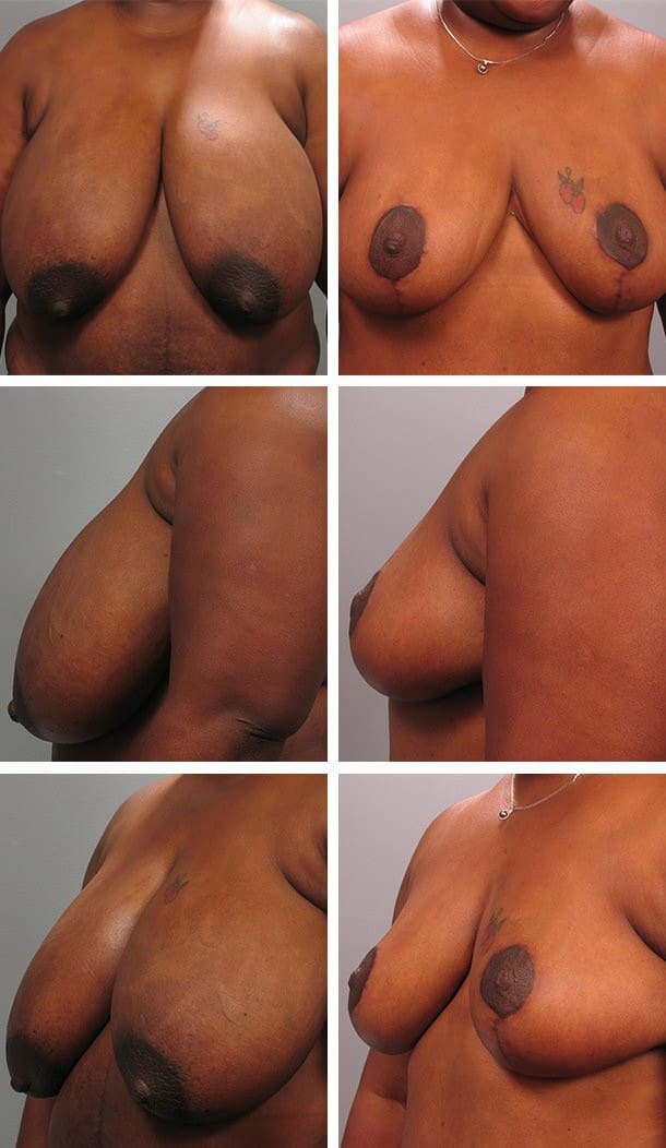 Before and After Image: Breast Reduction - other