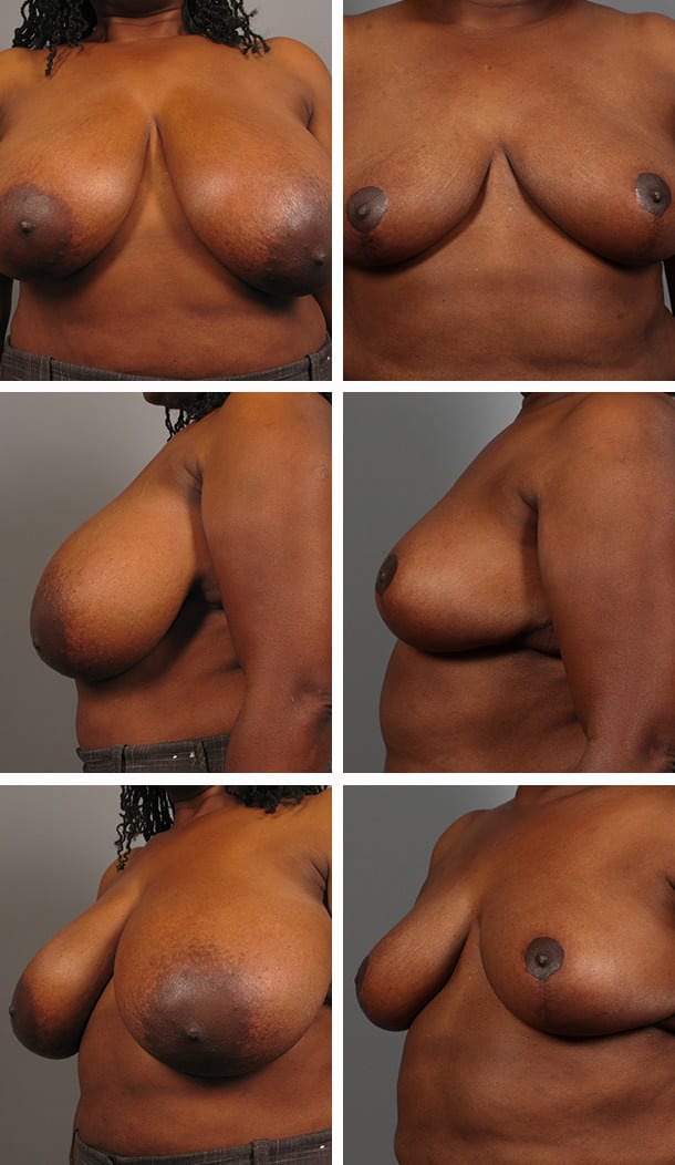 Before and After Image: Breast Reduction - other