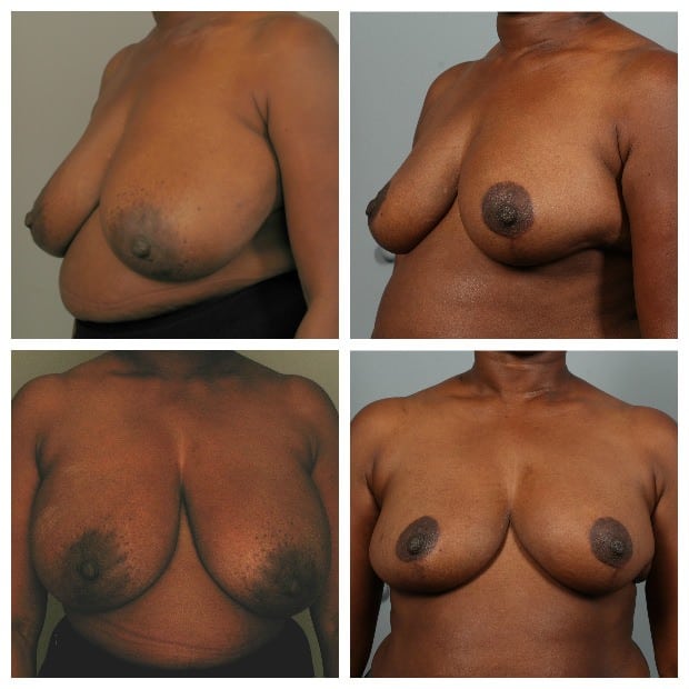 Before and After Image: Breast Reduction - other