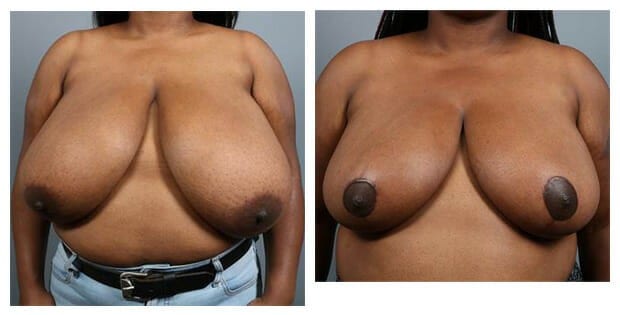 Before and After Image: Breast Reduction - front