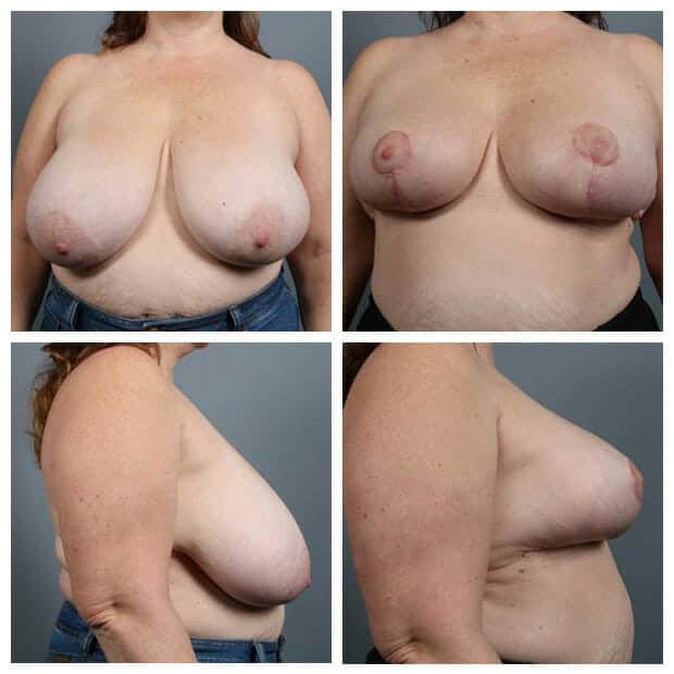 Before and After Image: Breast Reduction - other