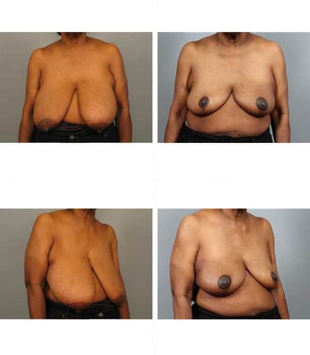 Before and After Image: Breast Reduction - other