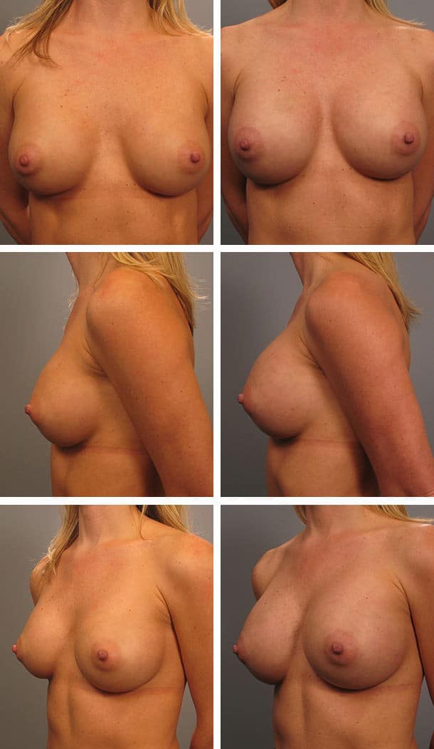Before and After Image: Breast Revision - other