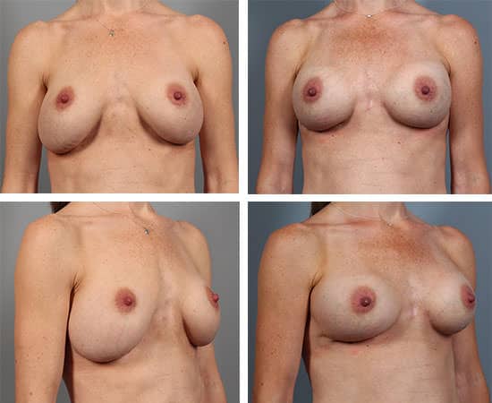 Before and After Image: Breast Revision - other