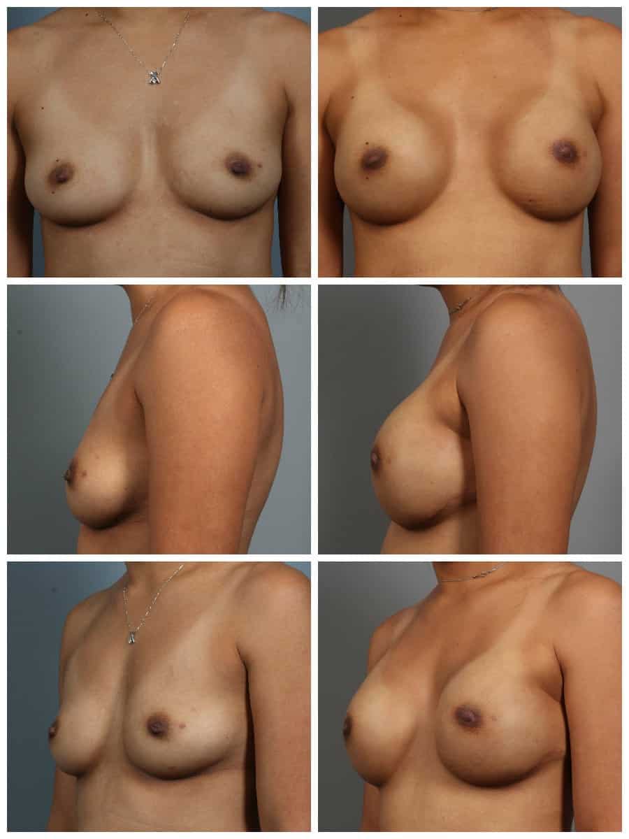 Before and After Image: Breast Revision - other