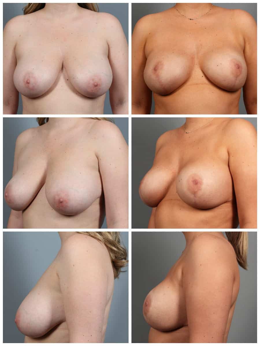 Before and After Image: Breast Revision - other