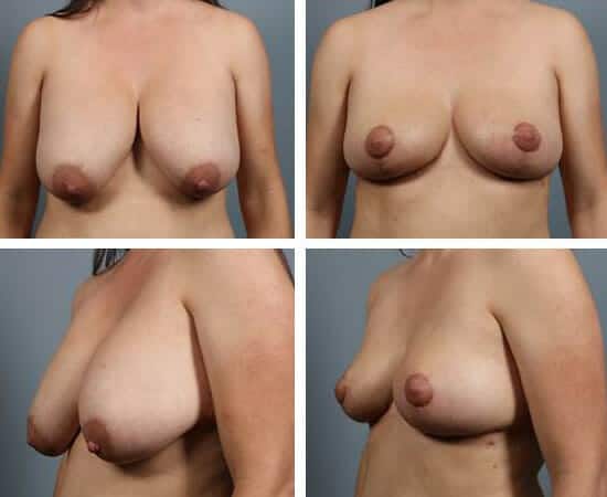 Before and After Image: Breast Revision - other