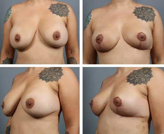 Before and After Image: Breast Revision - other