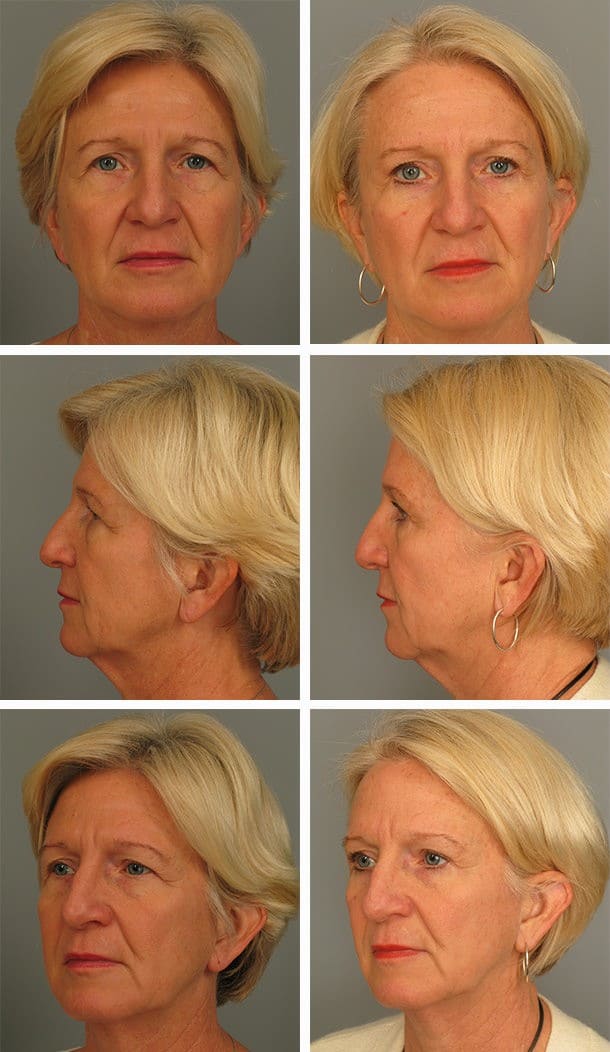 Before and After Image: Brow Lift - front