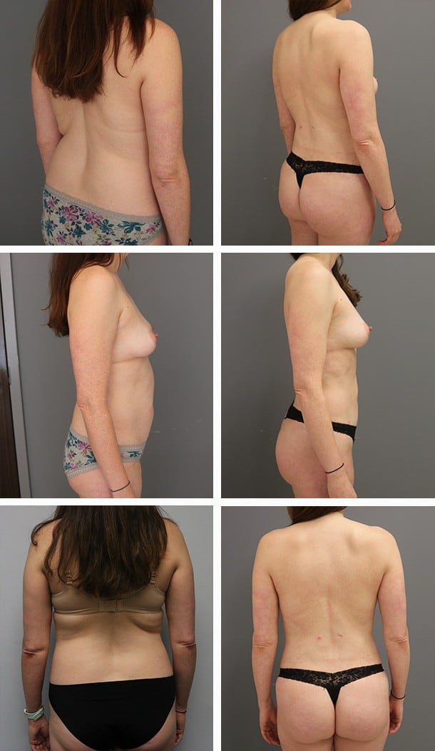Before and After Image: Butt Augmentation - other