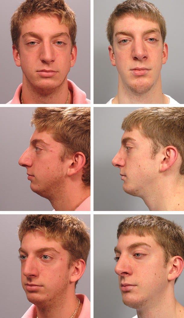 Before and After Image: Chin Augmentation - other