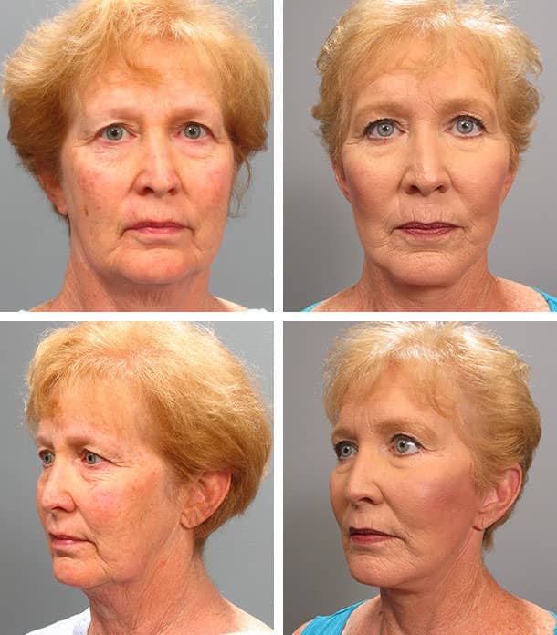 Before and After Image: Facelift - other