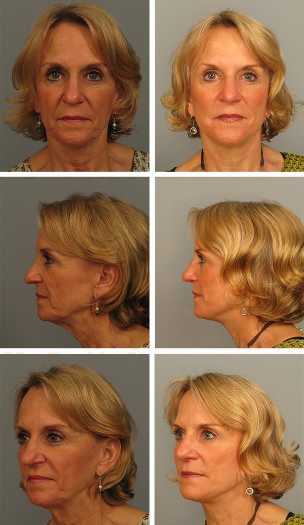 Before and After Image: Facelift - other