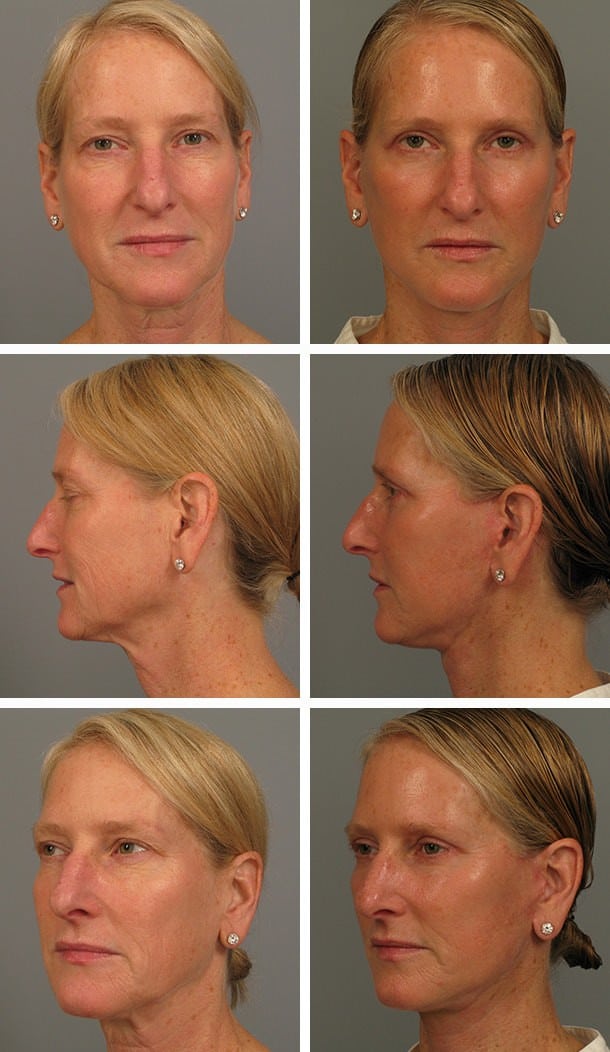 Before and After Image: Facelift - other