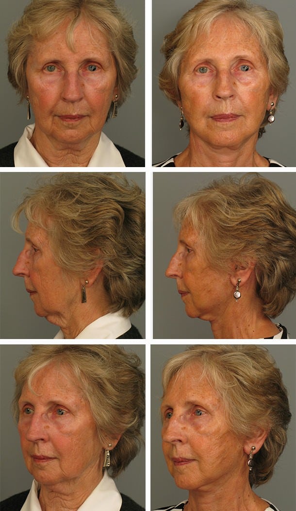 Before and After Image: Facelift - other