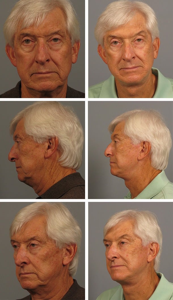 Before and After Image: Facelift - other