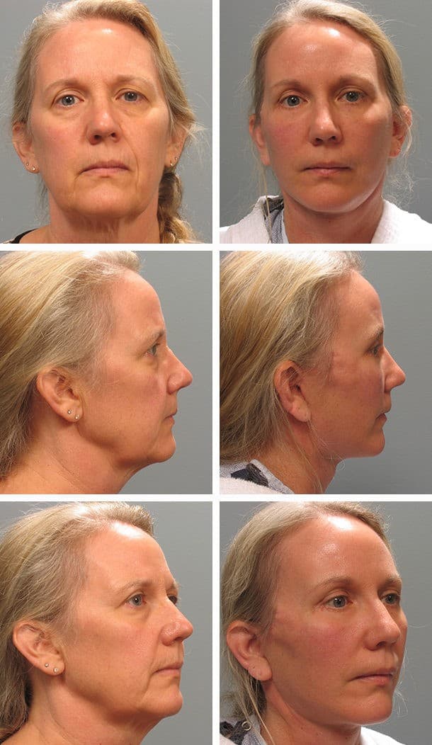 Before and After Image: Facelift - other