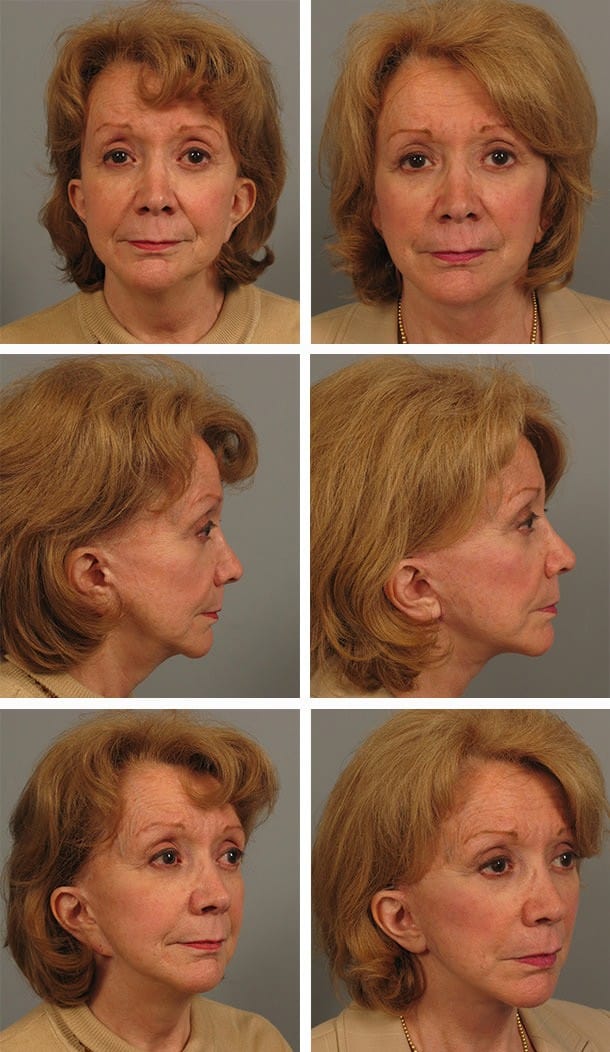 Before and After Image: Facelift - other