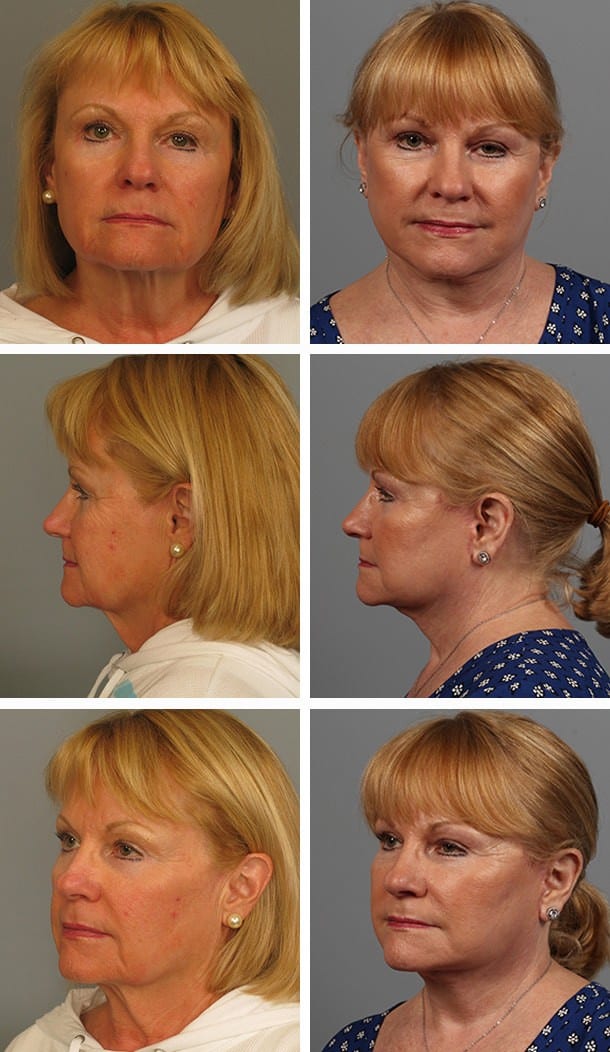 Before and After Image: Facelift - other