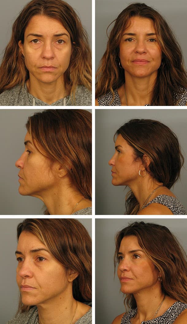 Before and After Image: Facelift - other