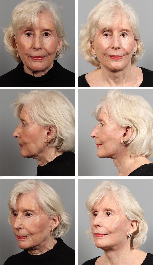 Before and After Image: Facelift - other