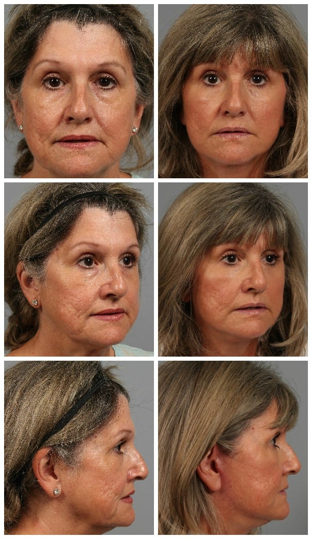 Before and After Image: Facelift - other