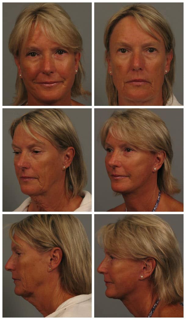 Before and After Image: Facelift - other