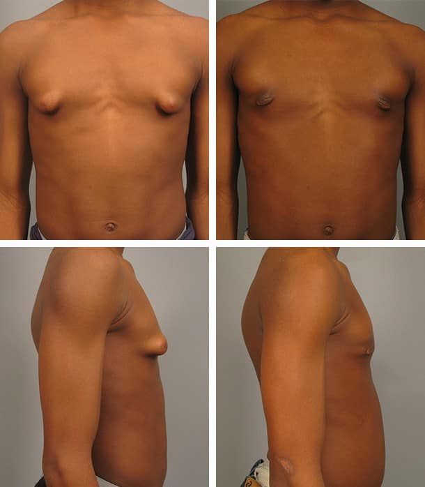 Before and After Image: Gynecomastia - other