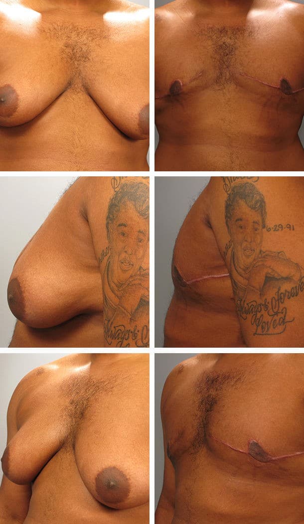 Before and After Image: Gynecomastia - other