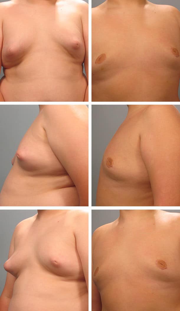 Before and After Image: Gynecomastia - other