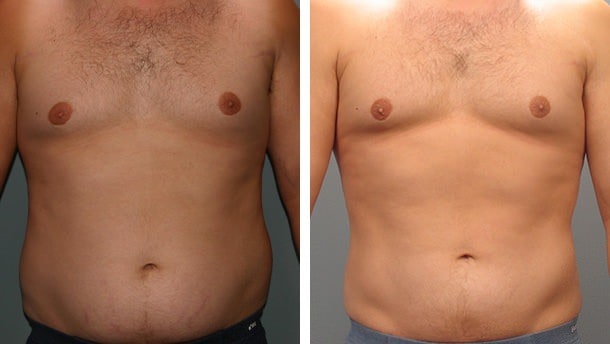 Before and After Image: Liposuction - front